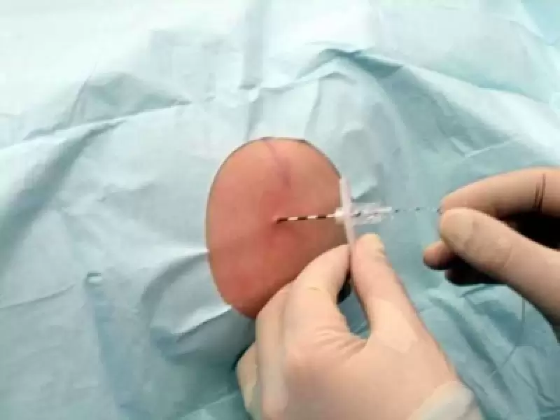 normal-dogumda-epidural-anestezi