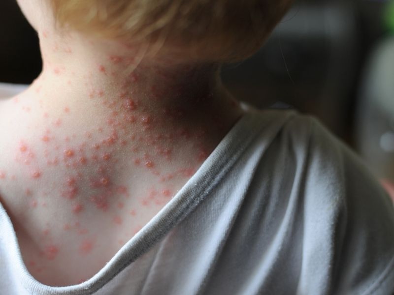 varisella-zoster-su-cicegi