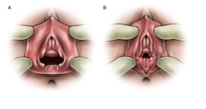 genital-estetik-nedir